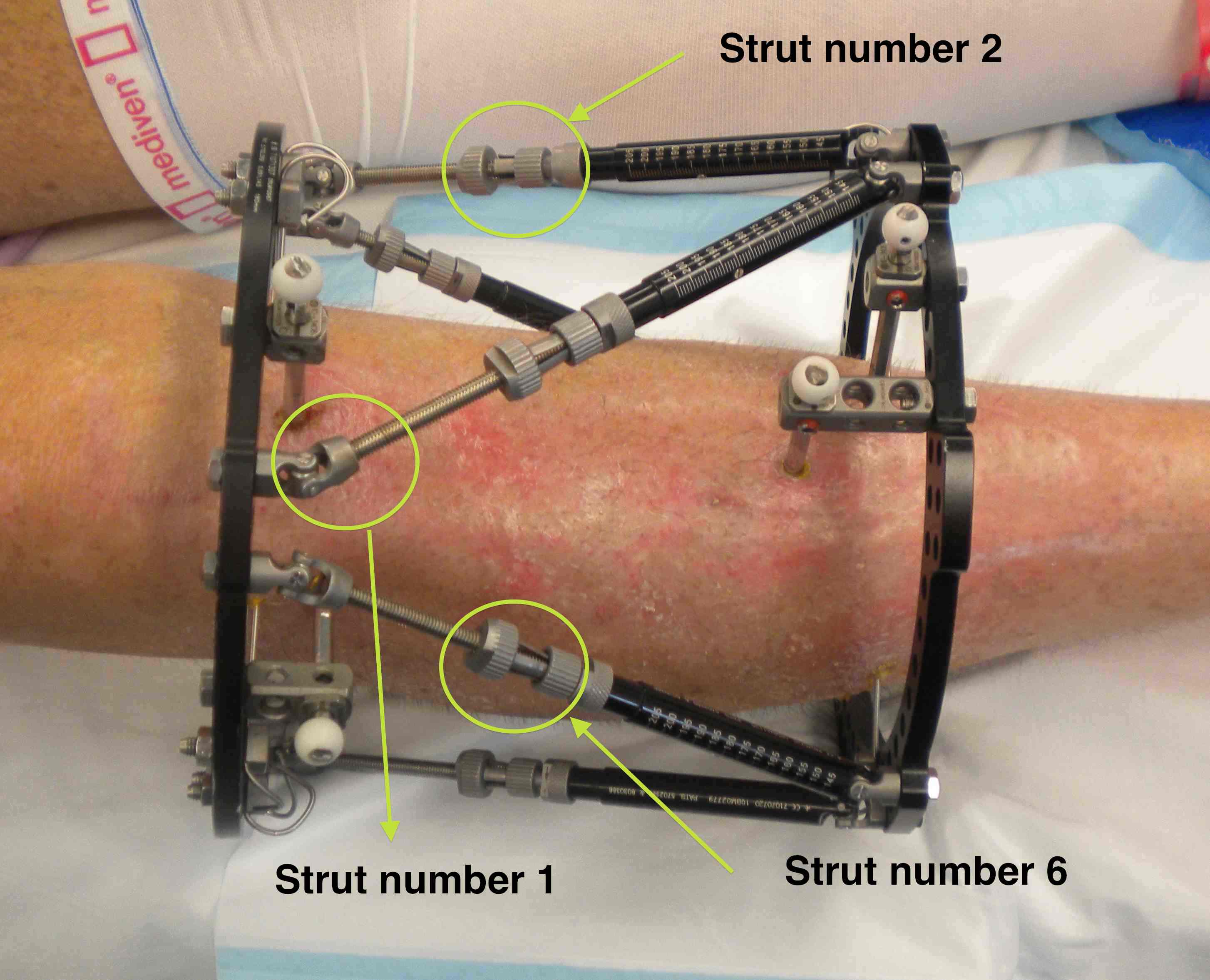 TSR Clinical Photo Struts